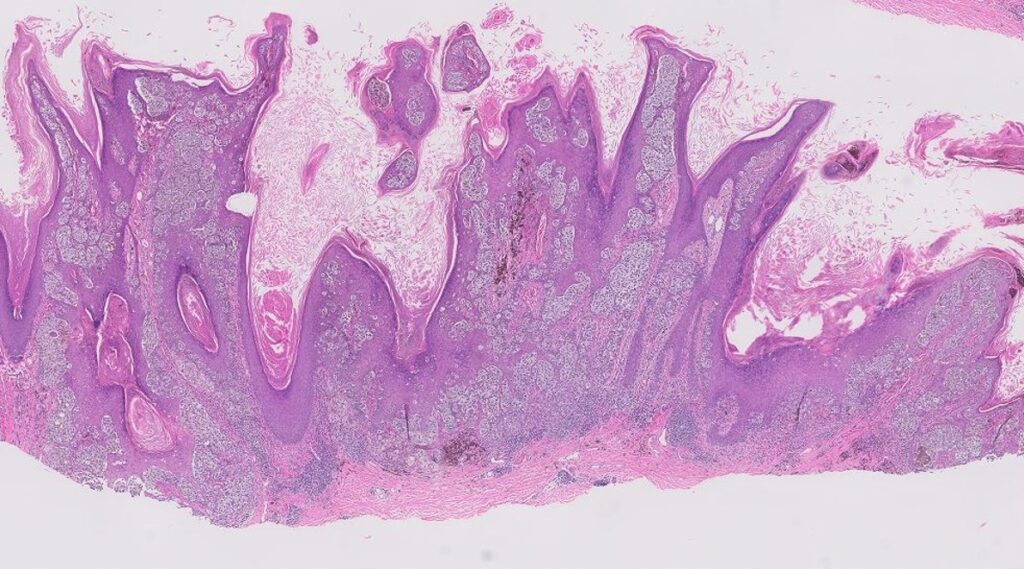 Dermatopathology Aspire Skin Health