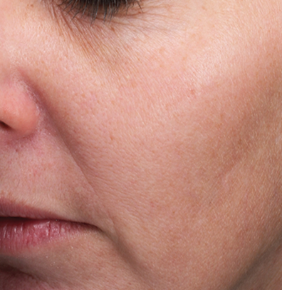 MOXI Fractional Laser - Aspire Skin Health