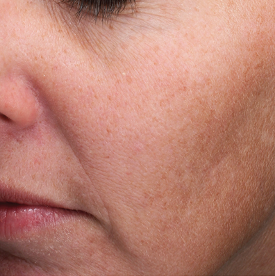 MOXI Fractional Laser - Aspire Skin Health