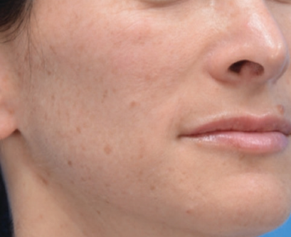 MOXI Fractional Laser - Aspire Skin Health